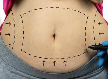 abdominoplastia-bilbao