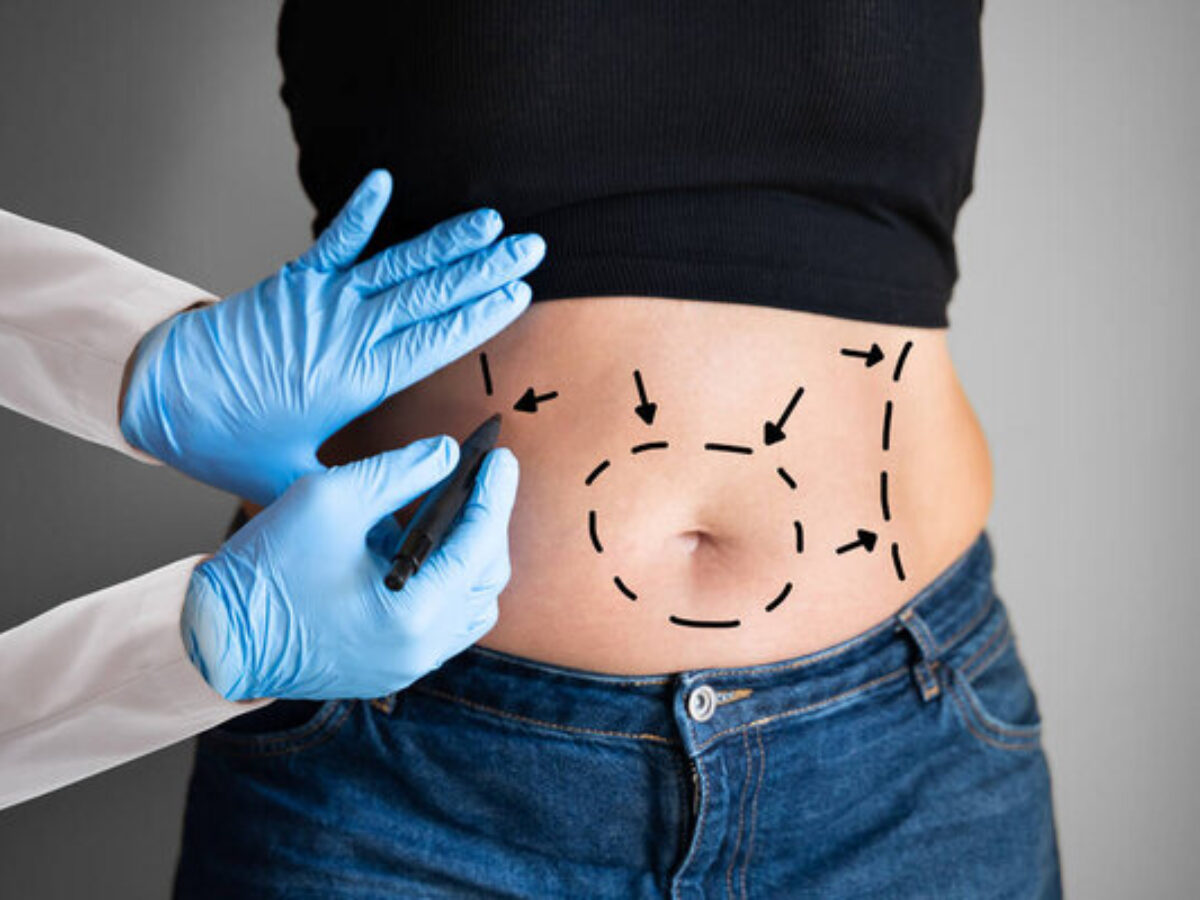 6.- Abdominoplastia: ¿Una persona con sobrepeso se puede