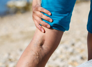 Mujer tocándose la pierna con varices