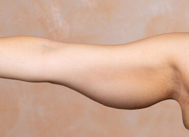 Mujer con brazo extendido muestra la piel colgante