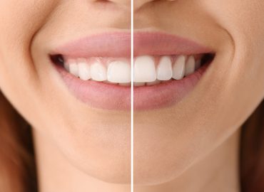 antes y después de una sonrisa gingival