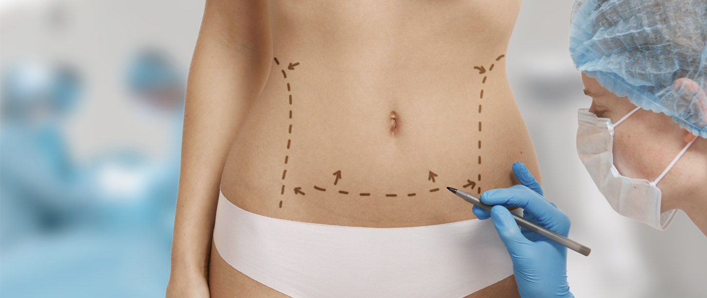 Médico dibujando líneas para una intervención de abdominoplastia